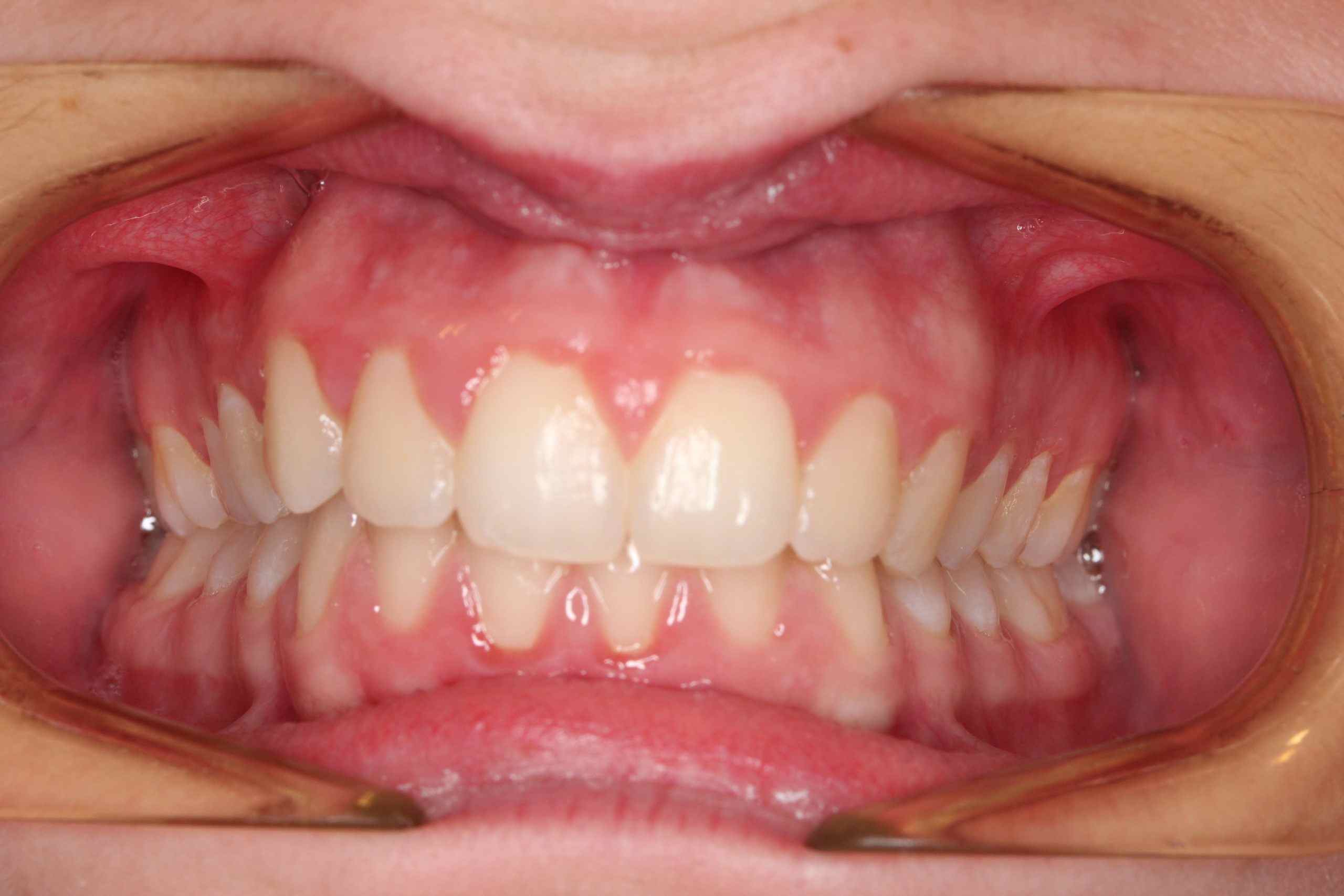 IMG_4908 Close-up of patient’s teeth and gums in a clinical dental setting
