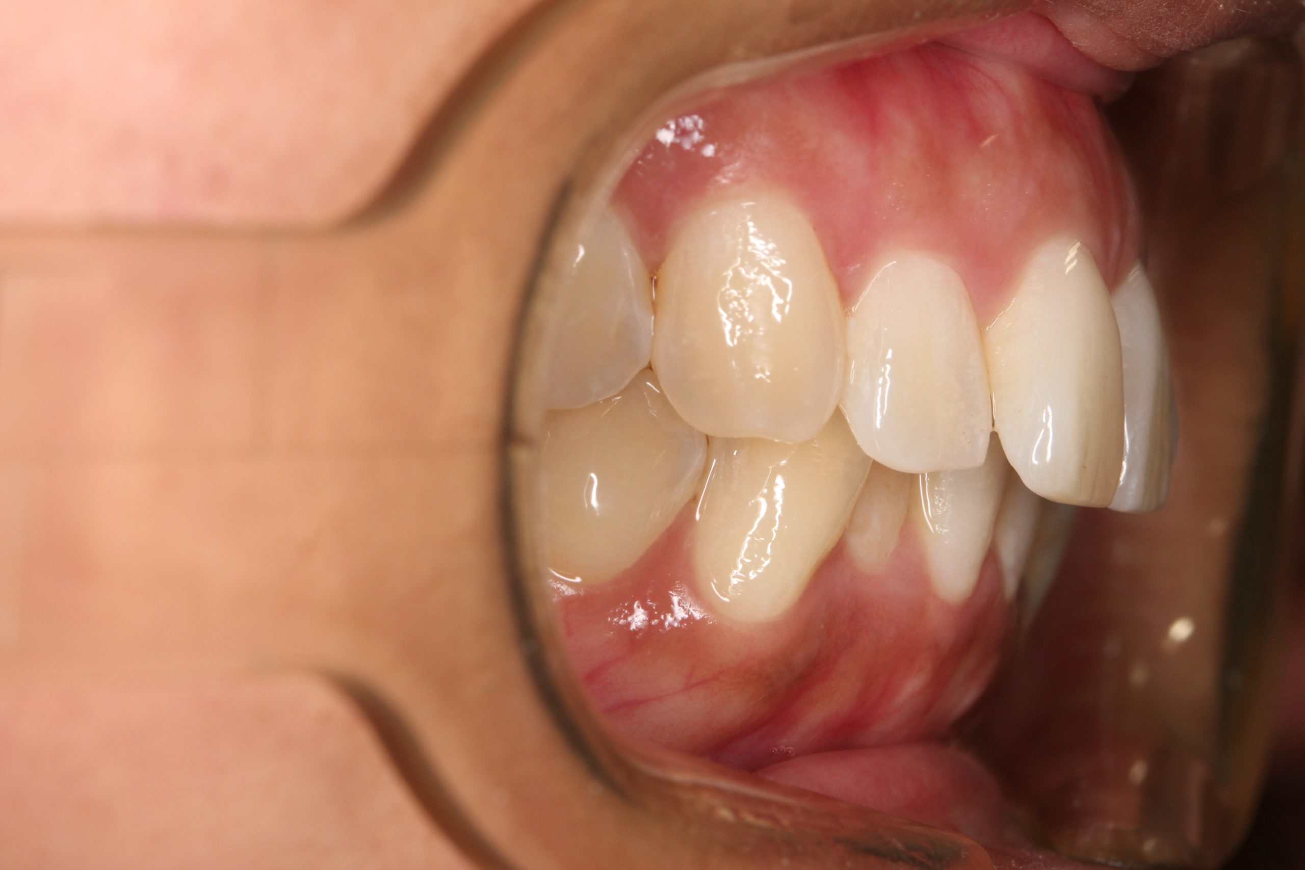 IMG_4911 Close-up of a patient’s teeth and gums during dental evaluation