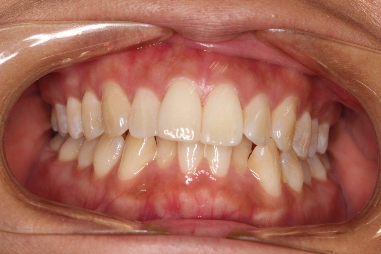 IMG_6869 Close-up of a patient’s mouth showing teeth and gums in a clinical dental setting