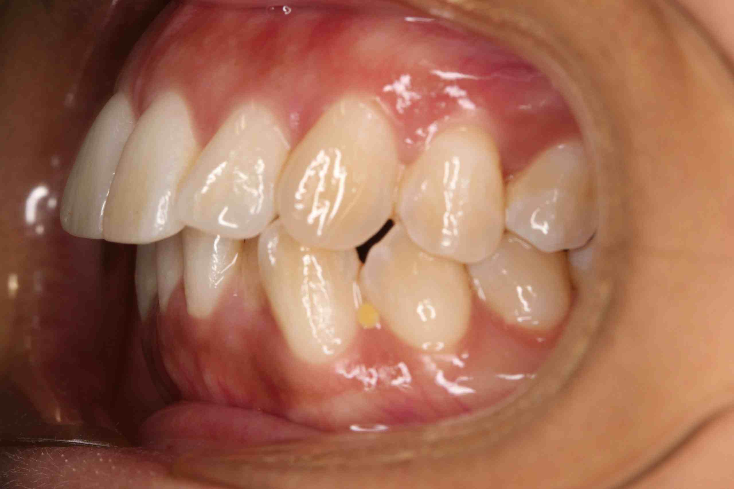 IMG_6873 Close-up of patient’s teeth and gums in a clinical setting