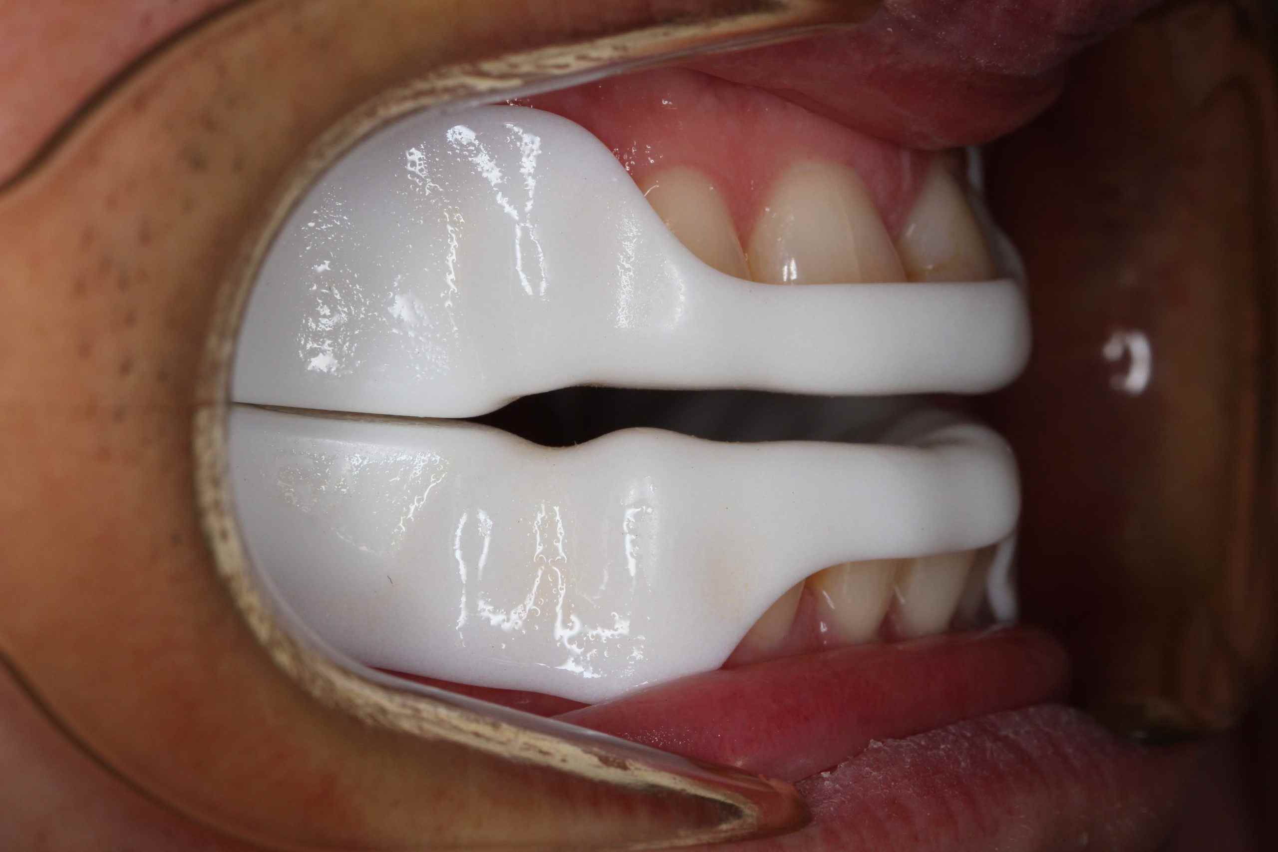 new Dorsal (1) New Dorsal mandibular advancement device in situ showing upper and lower jaw alignment
