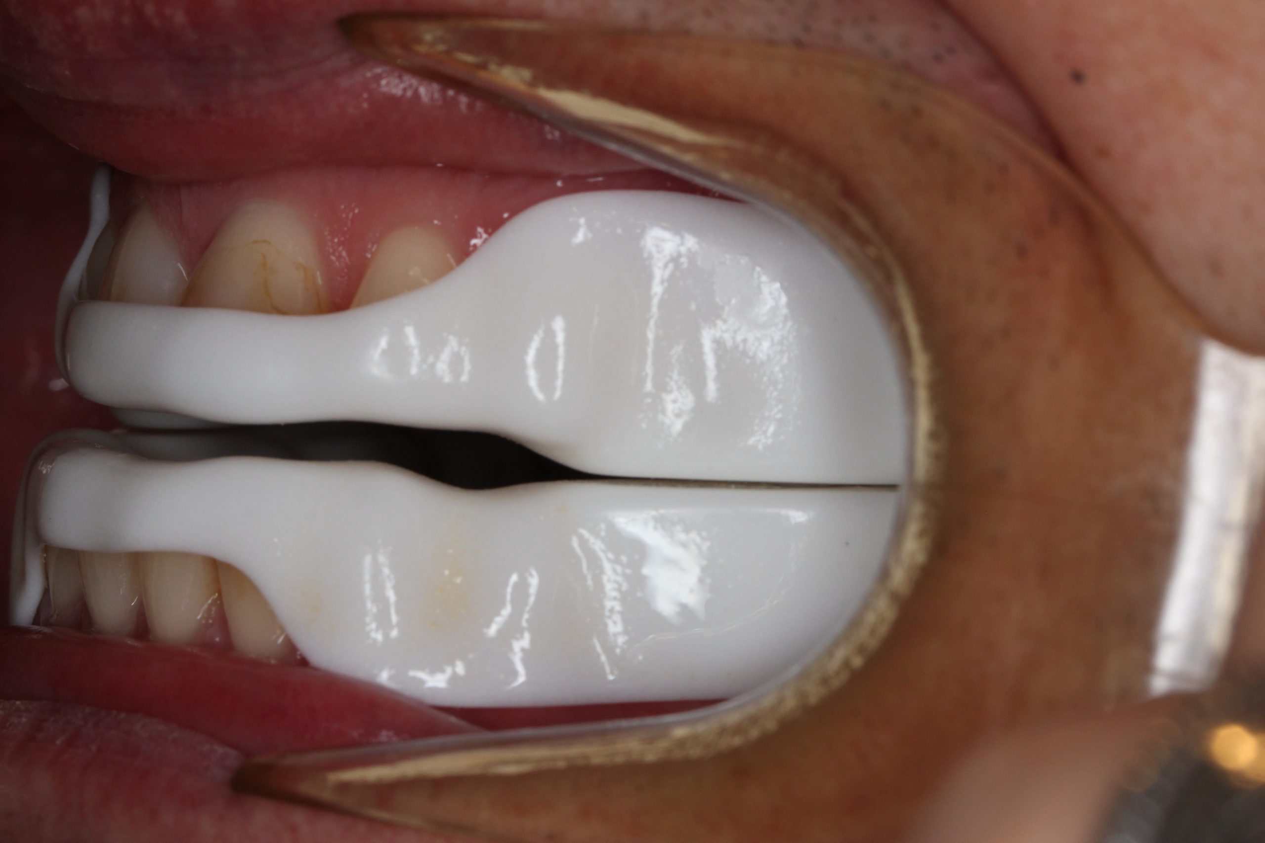 new Dorsal (2) New dorsal-style mandibular advancement splint showing teeth alignment