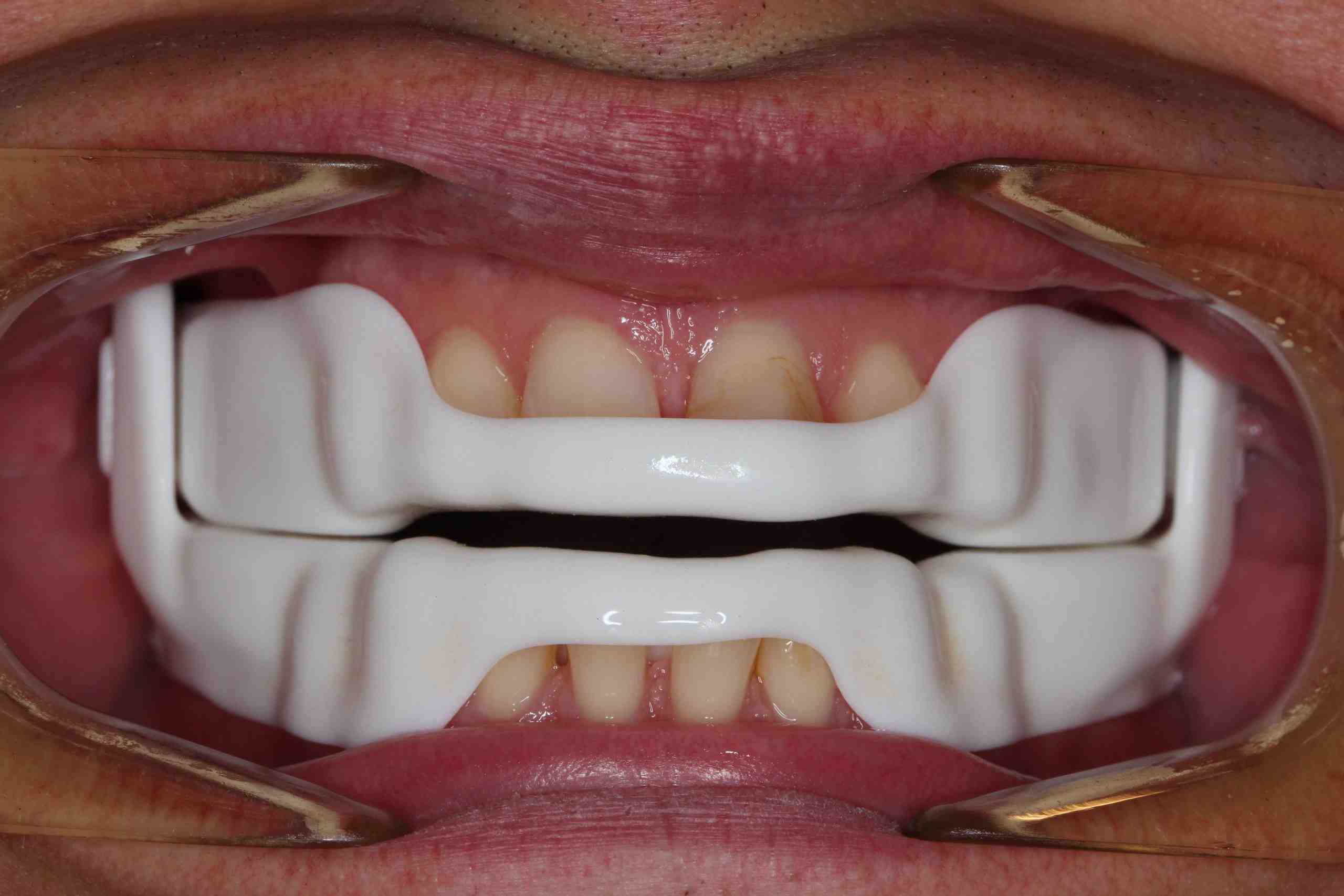 new Dorsal (3) New dorsal-style mandibular advancement device viewed from side in clinical setting